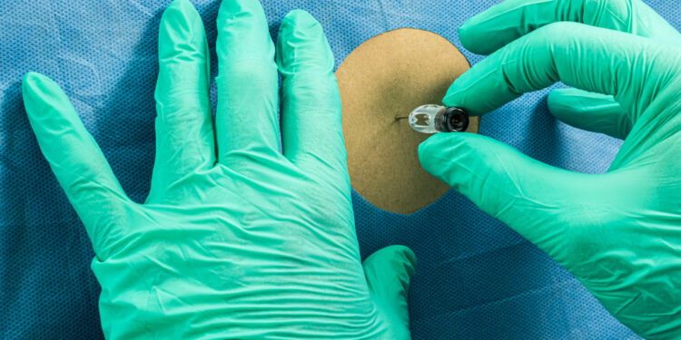 Paraneoplastiniai sindromai: simptomai, tipai ir gydymas