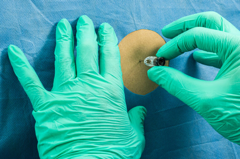 Paraneoplastiniai sindromai: simptomai, tipai ir gydymas