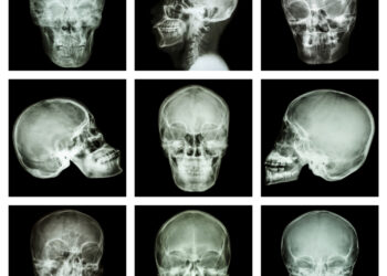 Hemiveidinis mikrosomijos sindromas: simptomai, priežastys ir gydymas