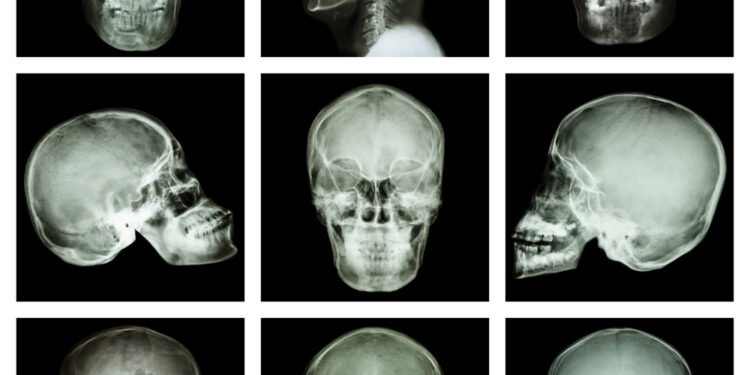 Hemiveidinis mikrosomijos sindromas: simptomai, priežastys ir gydymas