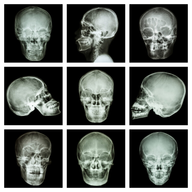 Hemiveidinis mikrosomijos sindromas: simptomai, priežastys ir gydymas