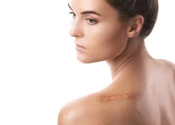 Keloidinė randė: kas tai, simptomai, gydymas ir šalinimas