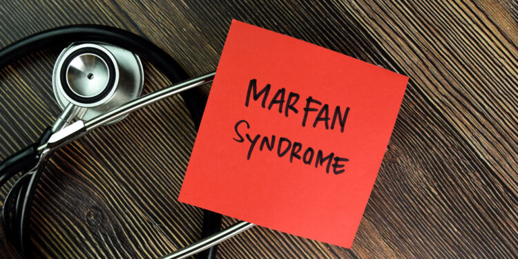 Sąnarių hipermobilumo sindromas: simptomai, priežastys, diagnostika ir gydymas