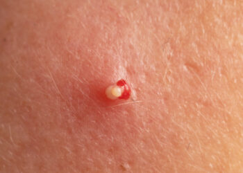 Merkelio ląstelių karcinoma: simptomai, priežastys, stadijos ir gydymas