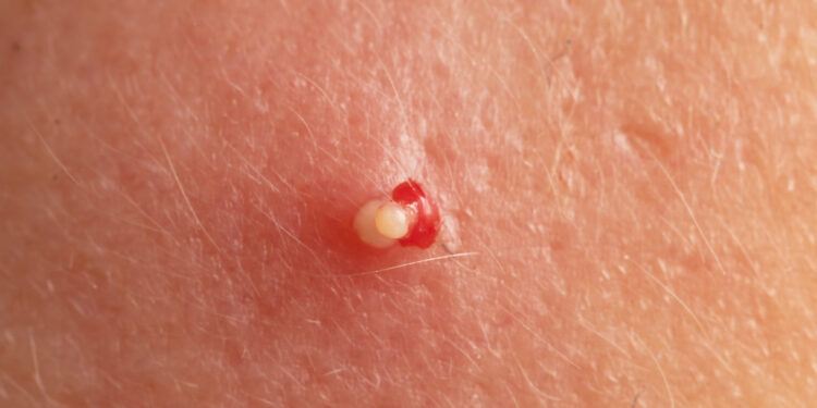 Merkelio ląstelių karcinoma: simptomai, priežastys, stadijos ir gydymas