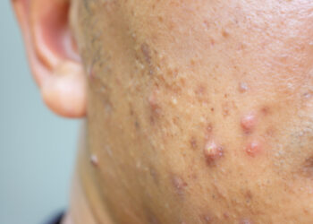 Mazginė aknė: kaip atpažinti, priežastys ir gydymas