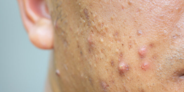Mazginė aknė: kaip atpažinti, priežastys ir gydymas