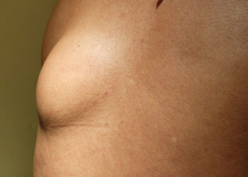 Lipoma: Kas tai, priežastys, simptomai, tipai, gydymas