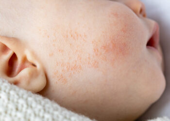 Naujagimių toksinė eritema: priežastys, simptomai, gydymas