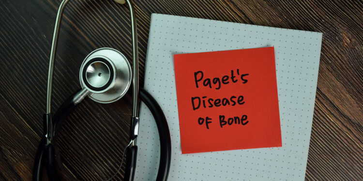 Kaulų Pageto liga: simptomai, priežastys ir gydymas