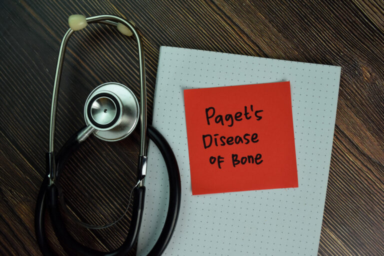 Kaulų Pageto liga: simptomai, priežastys ir gydymas