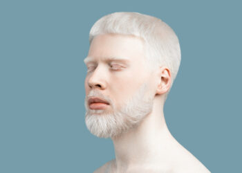 Akių ir odos albinizmas: kas tai, simptomai ir prognozė