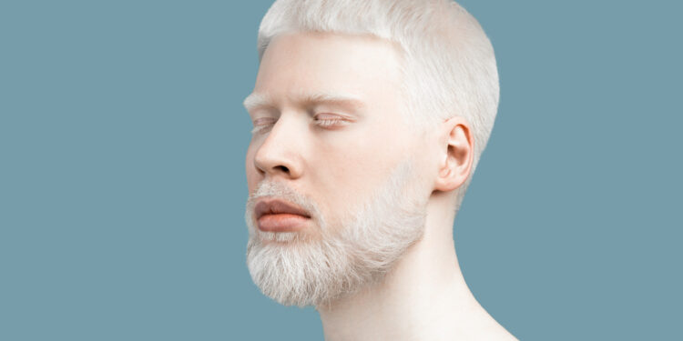 Akių ir odos albinizmas: kas tai, simptomai ir prognozė