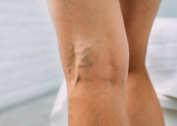 Venų varikozė: priežastys ir gydymas