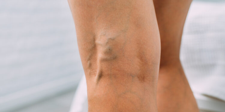 Venų varikozė: priežastys ir gydymas