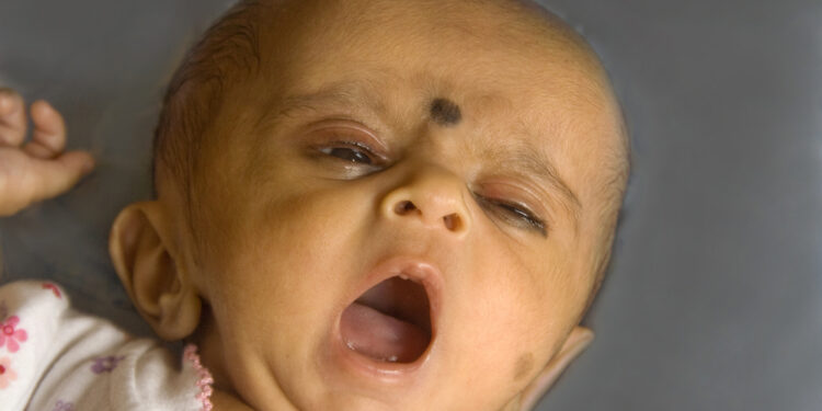 Makrocefalija: kas tai, priežastys, simptomai ir gydymas