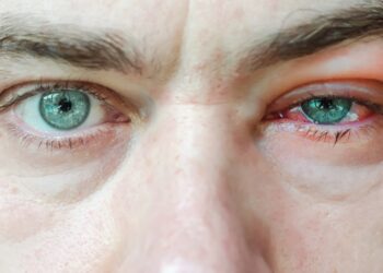 Keratokonjunktyvitas: rūšys, simptomai ir gydymas