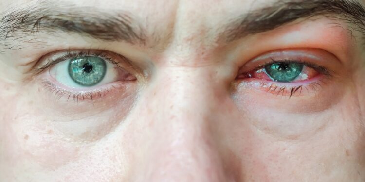 Keratokonjunktyvitas: rūšys, simptomai ir gydymas