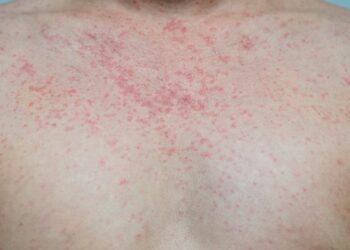 Kas yra histiocitozė?