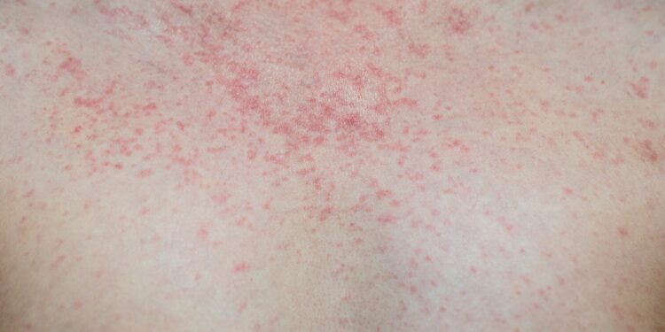 Kas yra histiocitozė?