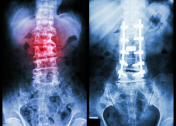 Kairinė ir dešininė skoliozė: skirtumai ir gydymas