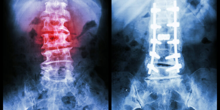 Kairinė ir dešininė skoliozė: skirtumai ir gydymas