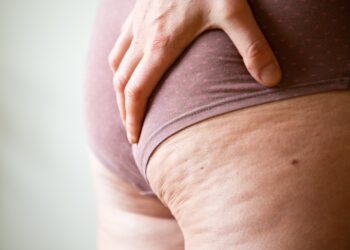 Riebalinė hipertrofija: simptomai, priežastys, gydymas ir profilaktika