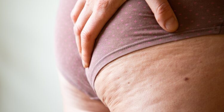 Riebalinė hipertrofija: simptomai, priežastys, gydymas ir profilaktika