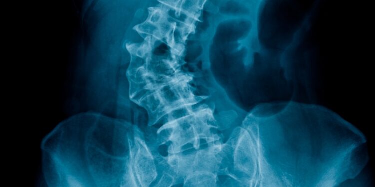 Skoliozė: kas tai, tipai, priežastys, simptomai ir gydymas