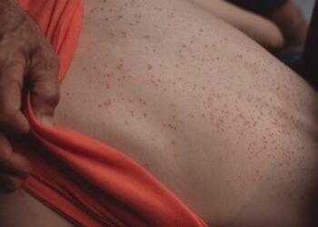 Šiluminis bėrimas (prakaito bėrimas): simptomai ir gydymas