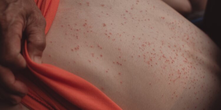 Šiluminis bėrimas (prakaito bėrimas): simptomai ir gydymas