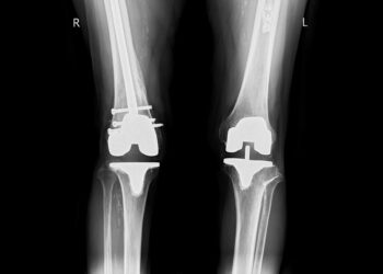 Hemihiperplazija: simptomai, priežastys ir gydymas