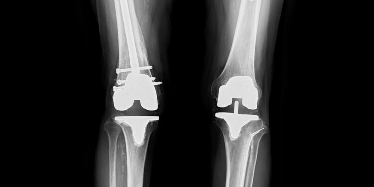 Hemihiperplazija: simptomai, priežastys ir gydymas