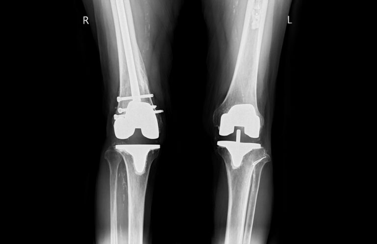 Hemihiperplazija: simptomai, priežastys ir gydymas