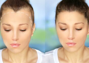 Moterų plikimas: simptomai, stadijos, priežastys ir gydymas