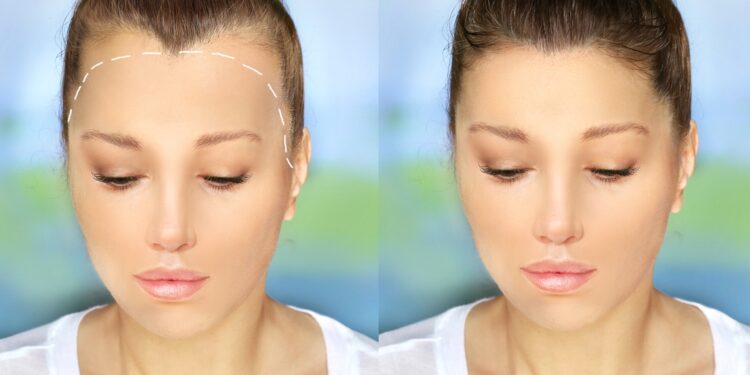 Moterų plikimas: simptomai, stadijos, priežastys ir gydymas