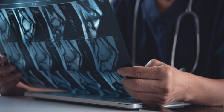 Osteoblastoma: kas tai, simptomai ir gydymas