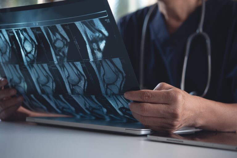 Osteoblastoma: kas tai, simptomai ir gydymas