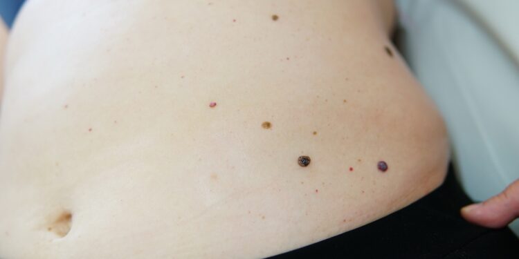 Gorlino sindromas (navikinių ląstelių bazalinių odos ląstelių sindromas)  arba  Gorlino sindromas (navikų nevozinio bazalinių ląstelių sindromas)Dažniausiai Lietuvos medicinos praktikoje vartojamas:  **Gorlino sindromas (nevozinis bazalinių ląstelių karcinomos sindromas)**Galutinis variantas:  **Gorlino sindromas (nevozinis bazalinių ląstelių karcinomos sindromas)**