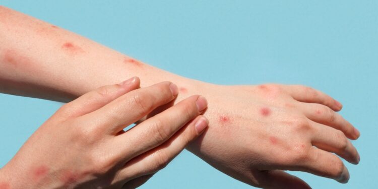 Marburgo viruso liga: priežastys, simptomai ir gydymas