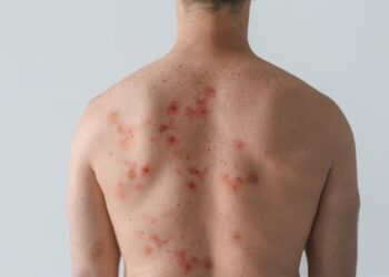 Imuninė trombocitopenija (ITP): simptomai, diagnostika ir gydymas