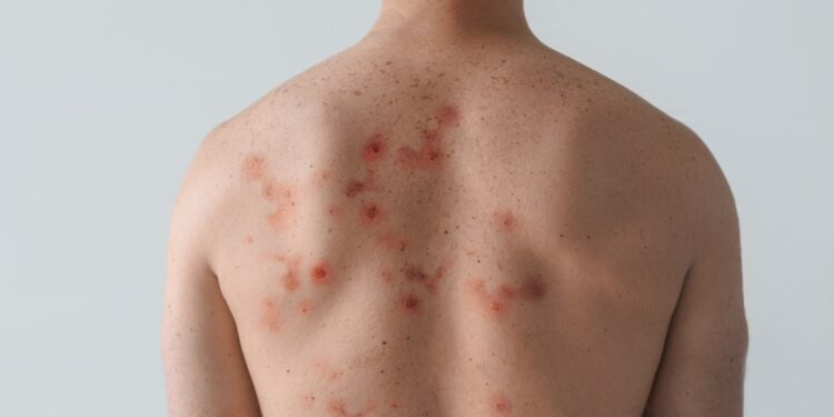 Imuninė trombocitopenija (ITP): simptomai, diagnostika ir gydymas