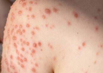 Oropučių viruso liga: priežastys, simptomai ir gydymas