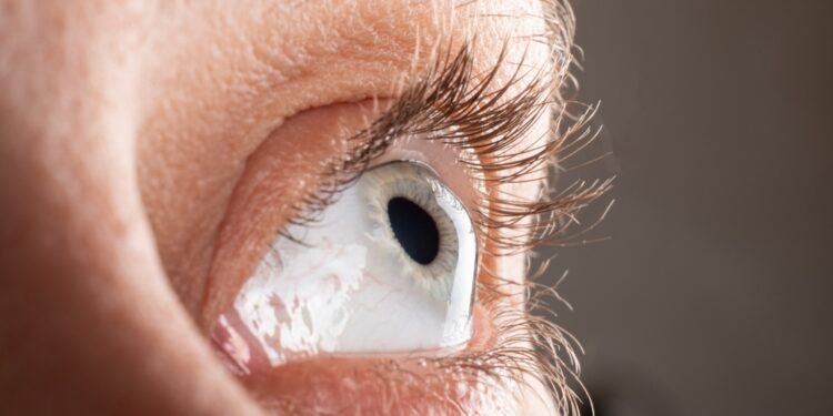 Keratokonas: simptomai, priežastys ir gydymas