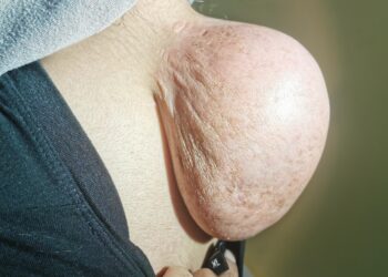 Fibrosarkoma: simptomai, priežastys ir gydymas