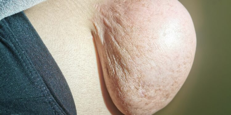 Fibrosarkoma: simptomai, priežastys ir gydymas