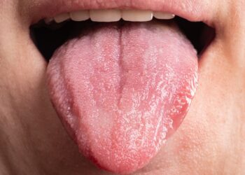 Makroglosija: apibrėžimas, priežastys ir gydymas