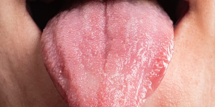 Makroglosija: apibrėžimas, priežastys ir gydymas