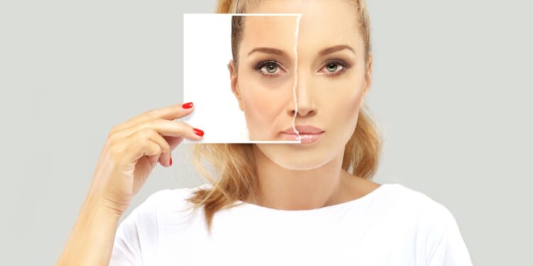 Marionečių linijos: kas tai, priežastys, užpildai ir gydymo būdai