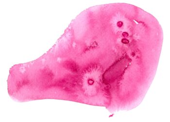 Papiliarinė fibroelastoma: simptomai, priežastys ir gydymas